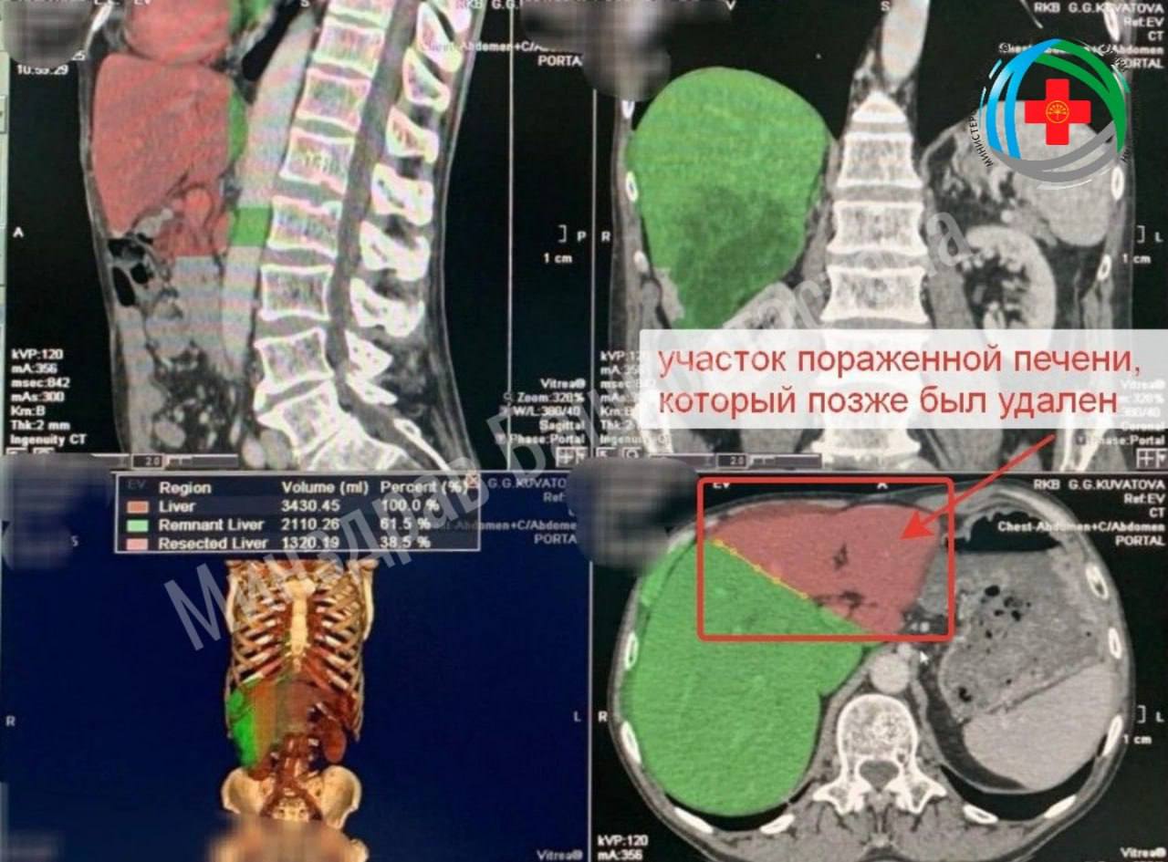 Жителю Башкирии «вырастили» новую печень