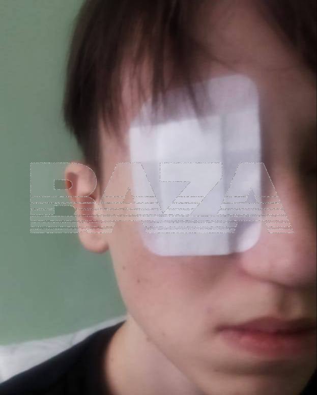 В Стерлитамаке 13-летний подросток лишился глаза из-за выстрела из пневматики — пуля у него до сих пор в голове