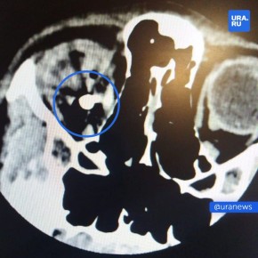 13-летний подросток выстрелил другу в глаз из пневматики — врачи до сих пор не могут достать пулю из головы