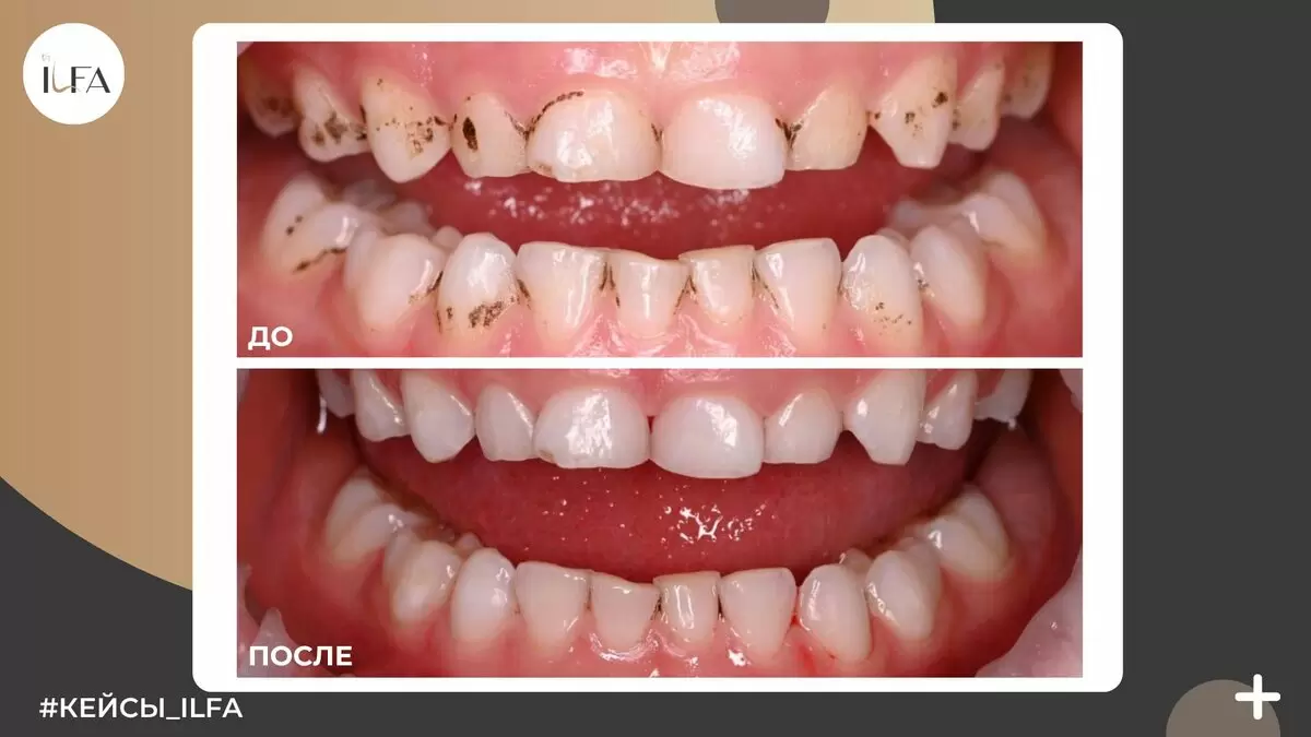 Налёт Пристли: что это такое и как его эффективно удалить?